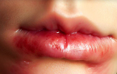 Angular Cheilitis